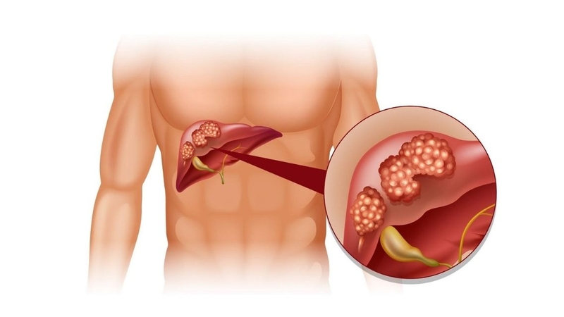 Ung thư gan giai đoạn 1 sống được bao lâu là thắc mắc của hầu hết người bệnh