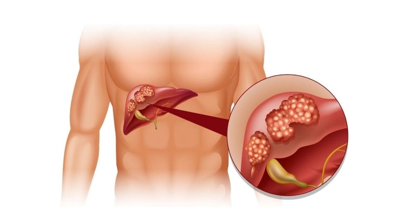 Ung thư gan giai đoạn 3 có chữa được không tùy đặc điểm bệnh của từng bệnh nhân
