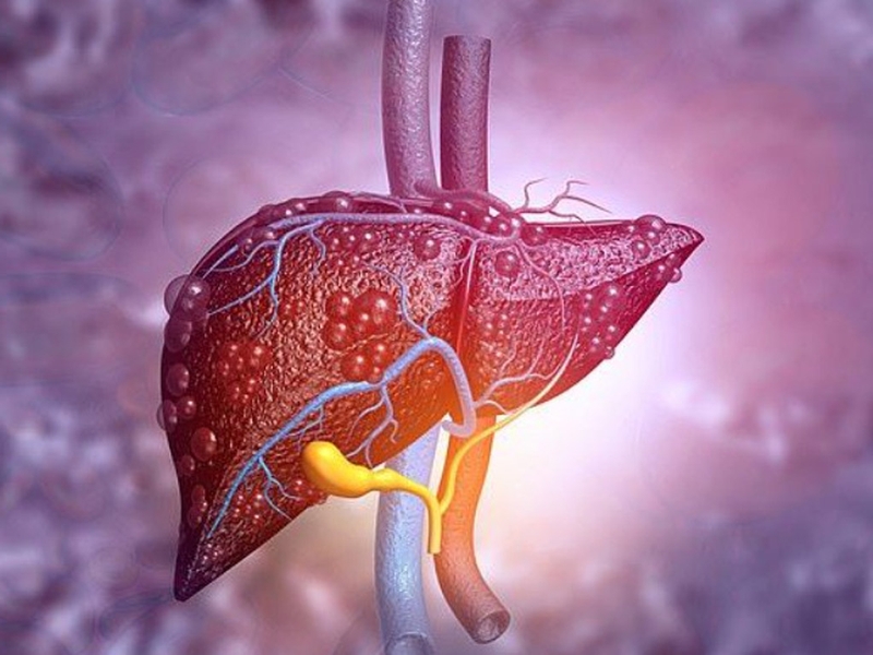 ung thư gan giai đoạn cuối 1