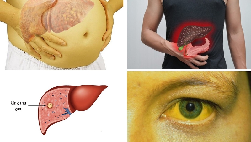 ung thư gan giai đoạn cuối 3