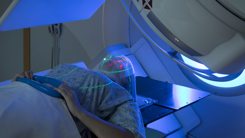 Chỉ định xạ trị ở ung thư giai đoạn 1