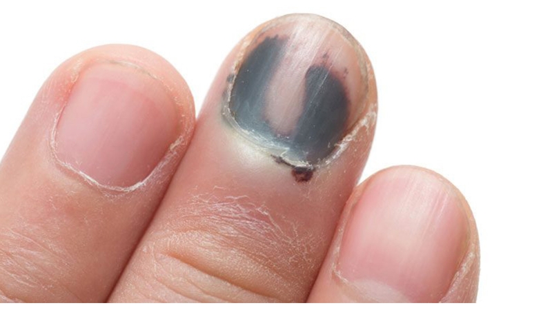 Giải đáp: Ung thư hắc tố móng tay sống được bao lâu? 1