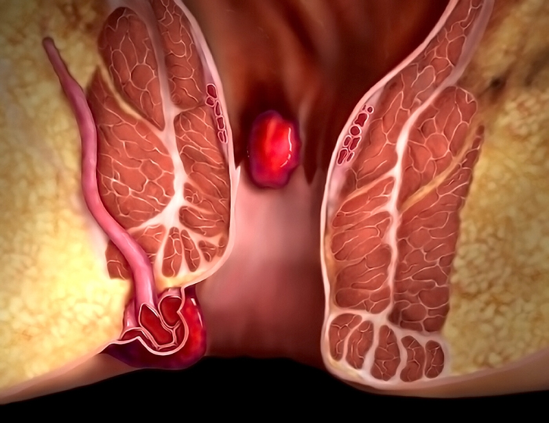 Ung thư hậu môn sống được bao lâu? Làm gì để kéo dài sự sống 1