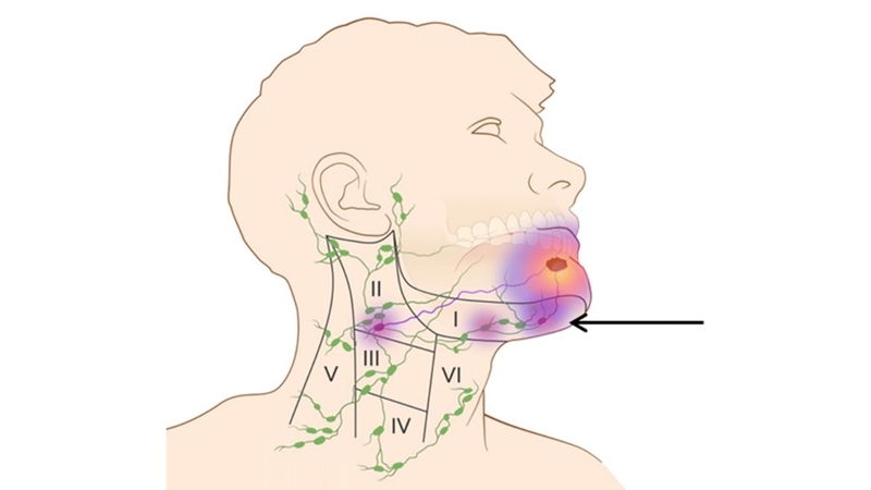 Sự hiện diện của di căn hạch làm tăng nguy cơ xuất hiện di căn xa