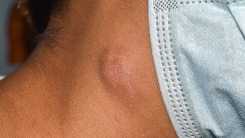 Nổi hạch cổ to, cứng, ít di động