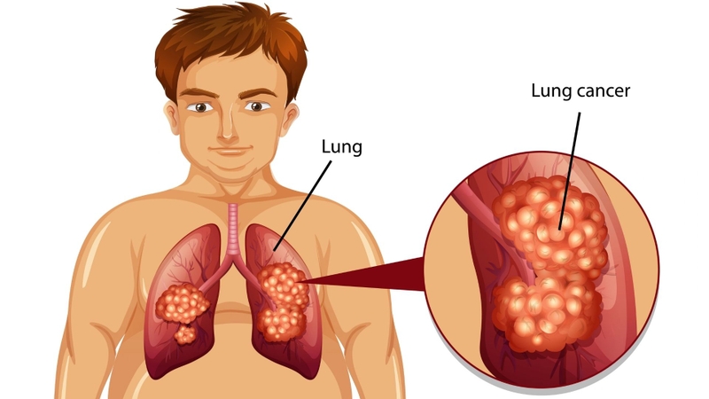 Tầm soát sức khỏe định kỳ giúp phát hiện bệnh sớm và tăng hiệu quả điều trị