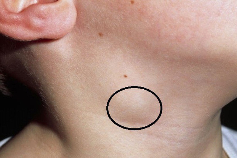 Ung thư phổi di căn hạch ở cổ nguy hiểm như thế nào 1