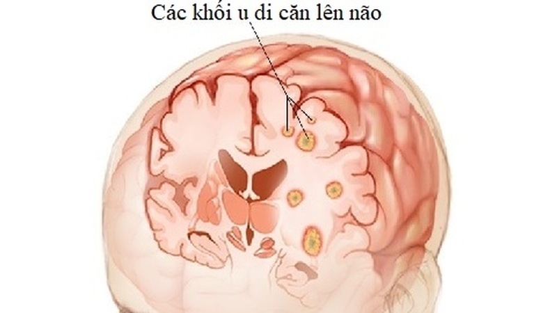 Ung thư phổi di căn não: Biểu hiện, chẩn đoán và điều trị  1