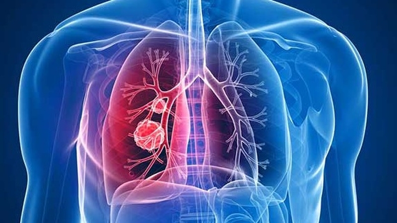 Ung thư phổi di căn não và xương có chữa được không? 2