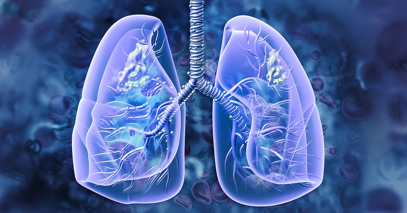 Thế nào là ung thư phổi di căn?2