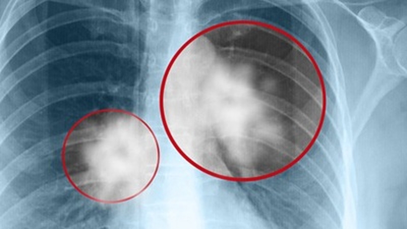 Ung thư phổi di căn xương có triệu chứng gì? Sống được bao lâu? 1
