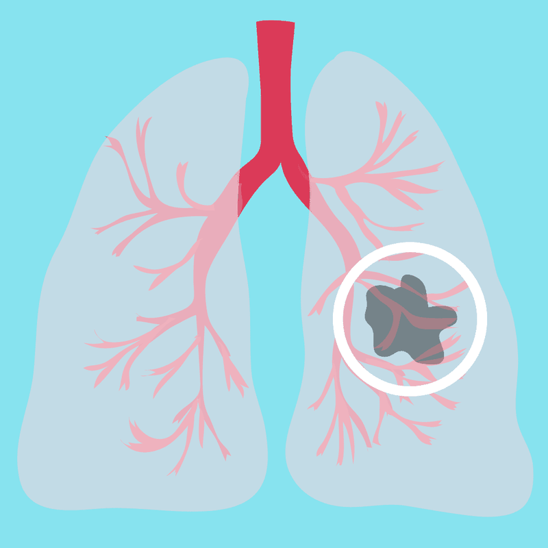 Ung thư phổi giai đoạn đầu có chữa được không?2