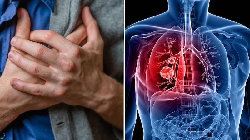 Ung thư phổi giai đoạn đầu sống được bao lâu? Các yếu tố ảnh hưởng đến thời gian sống của bệnh nhân 1