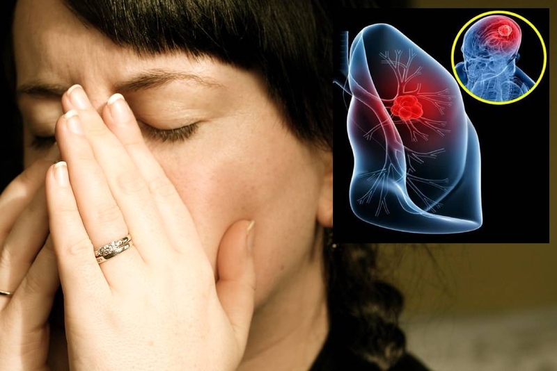 Ung thư phổi giai đoạn đầu sống được bao lâu? Các yếu tố ảnh hưởng đến thời gian sống của bệnh nhân 2
