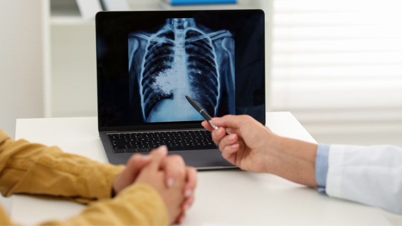 Ung thư phổi ho ra máu sống được bao lâu? Phụ thuộc vào nhiều yếu tố khác nhau