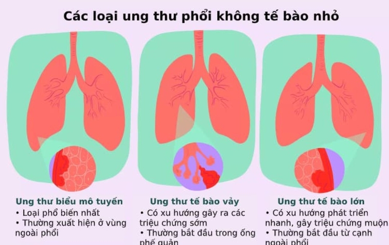 Ung thư phổi không tế bào nhỏ là gì và biểu hiện sớm của bệnh 1