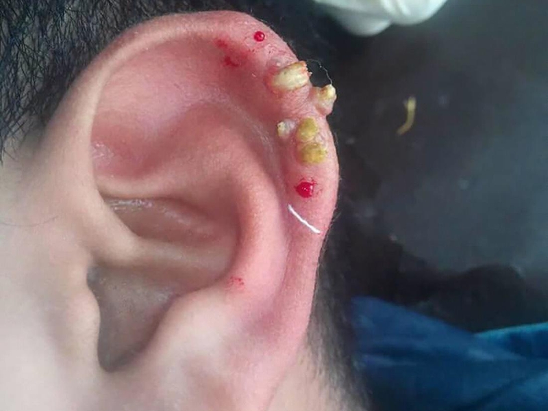 Ung thư tai có chữa được không?1