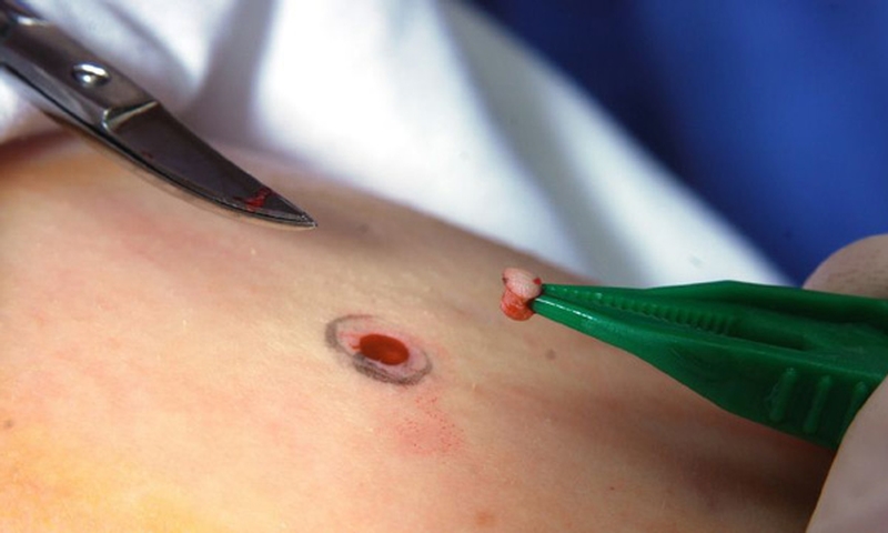 Phương pháp điều trị ung thư hắc tố ác tính theo giai đoạn1