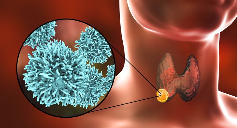 Ung thư tế bào Hurthle: Căn bệnh hiếm gặp trong ung thư tuyến giáp 2
