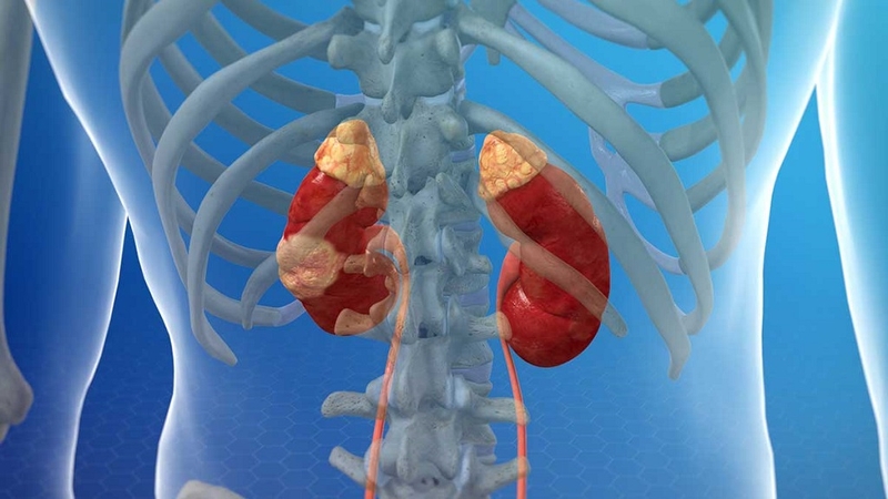 Ung thư thận có chữa được không? Ung thư thận điều trị ra sao và sống được bao lâu? 1