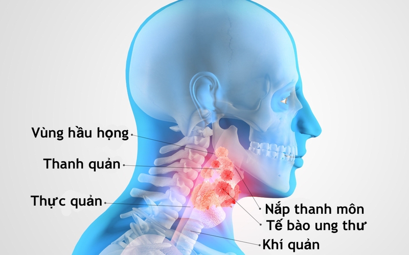 Ung thư thanh quản giai đoạn cuối: Các triệu chứng, cách điều trị và chăm sóc 1