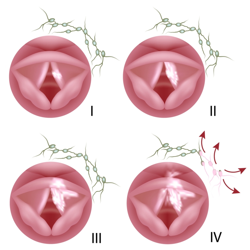 Ung thư thanh quản là gì? Người bị ung thư thanh quản sống được bao lâu? 4