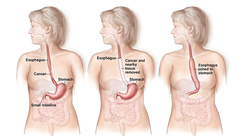 Ung thư thực quản có nên mổ không? Lợi hay hại nhiều hơn? 2