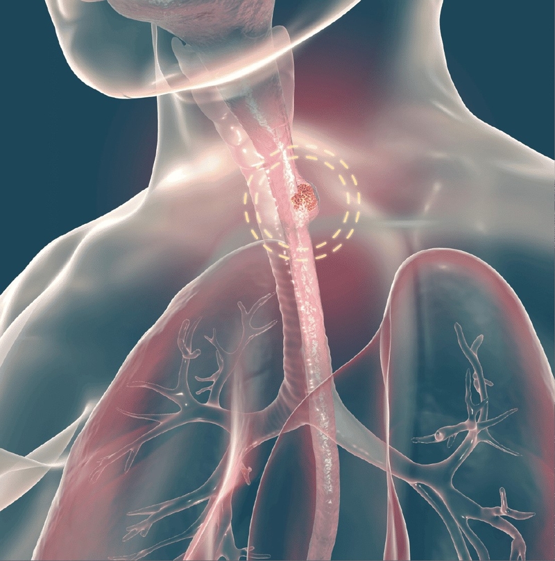 Ung thư thực quản là gì? Ung thư thực quản có chữa được không? 4