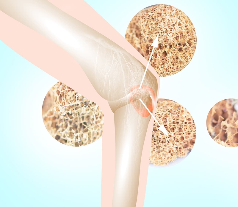 Ung thư tủy xương là gì? Phòng ngừa ung thư tủy xương 1