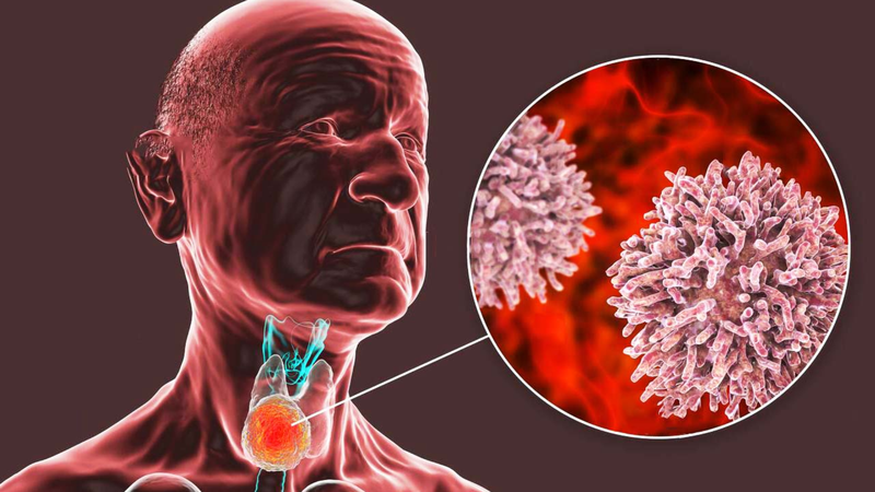 Ung thư tuyến cận giáp 2