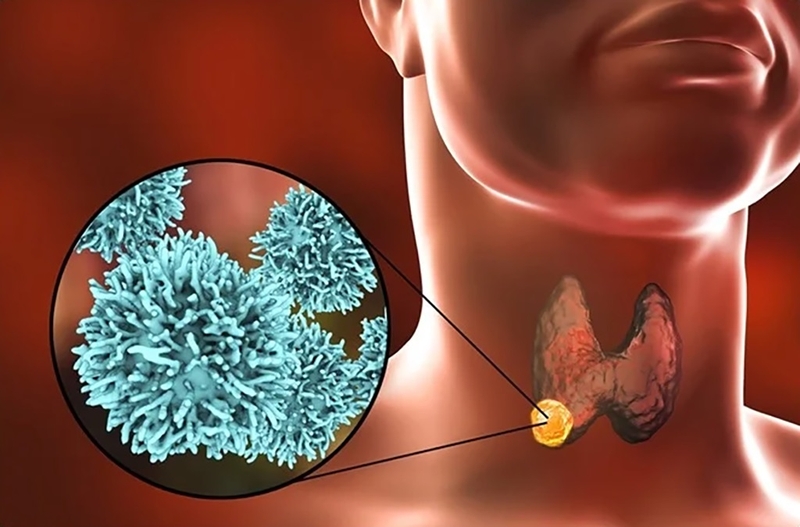 Bệnh ung thư tuyến giáp có di truyền không? Quy trình xét nghiệm ung thư tuyến giáp 1