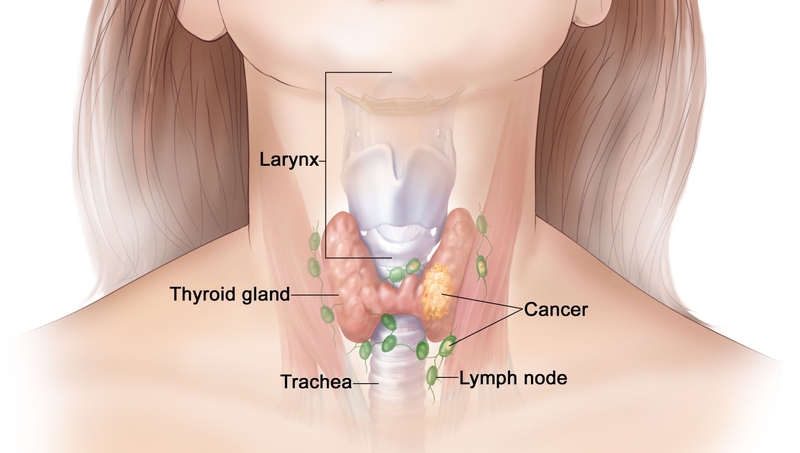 Ung thư tuyến giáp di căn có chữa được không? 2