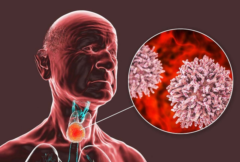 Ung thư tuyến giáp thể nhú sống được bao lâu và tỷ lệ sống sót, điều trị như thế nào? 2