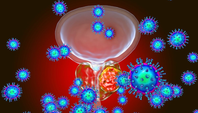 Ung thư tuyến tiền liệt tái phát: Nguyên nhân, triệu chứng, cách điều trị 1