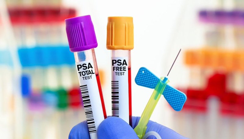 Ung thư tuyến tiền liệt tái phát: Nguyên nhân, triệu chứng, cách điều trị 3