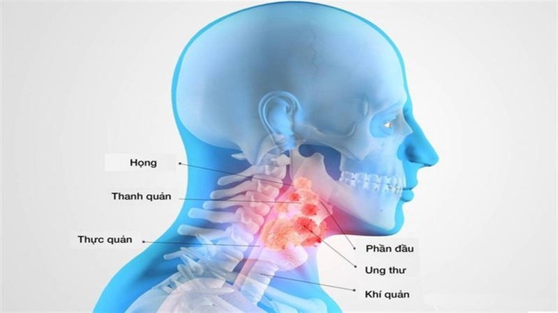 Ung thư vòm họng có nguy hiểm không? Nguyên nhân và cách điều trị 3
