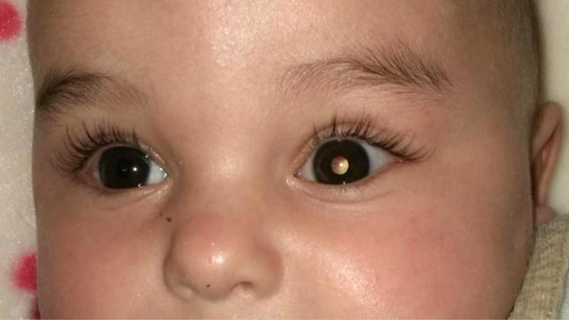 Ung thư võng mạc là gì? Nguyên nhân, biểu hiện và cách điều trị 2