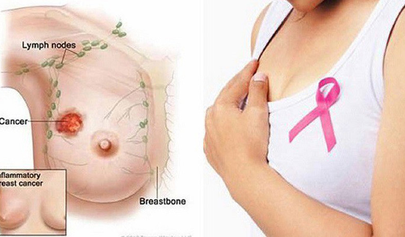 Ung thư vú dạng sàng rất hiếm gặp