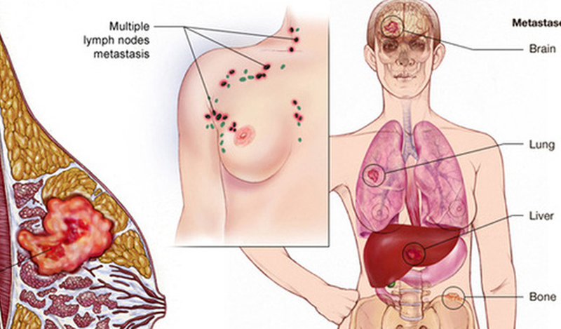 Liệu pháp nội tiết trong điều trị ung thư vú
