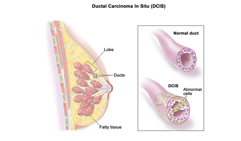 Ung thư vú dạng sàng tiên lượng sau điều trị tốt