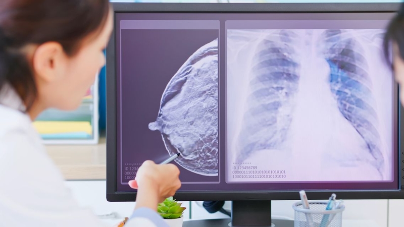 Rất nhiều người muốn biết ung thư vú di căn có chữa được không