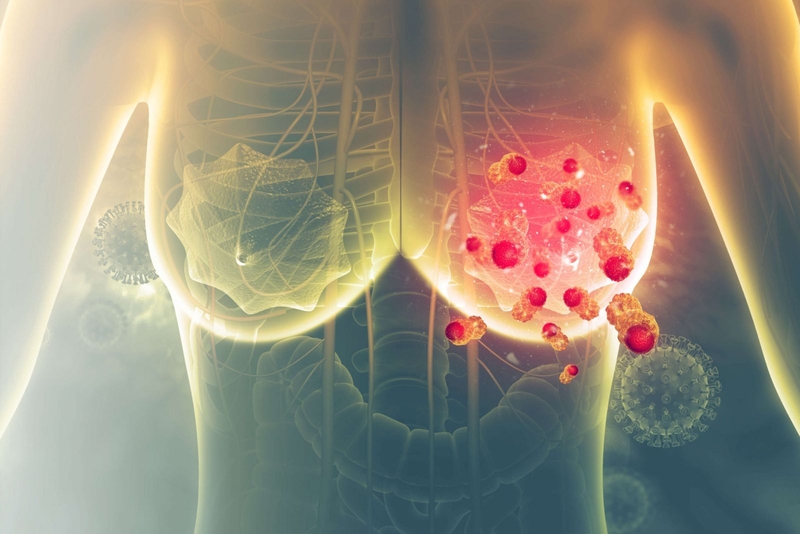 Ung thư vú di căn gan là gì?1