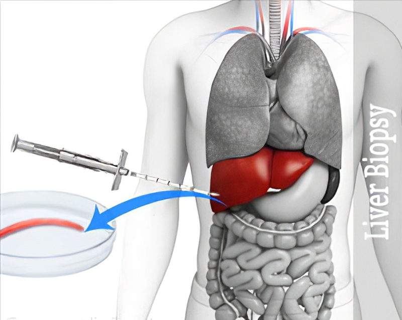 Ung thư vú di căn gan là gì?4