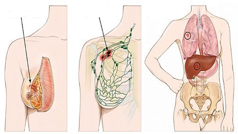 Ung thư vú lây lan di căn phổi
