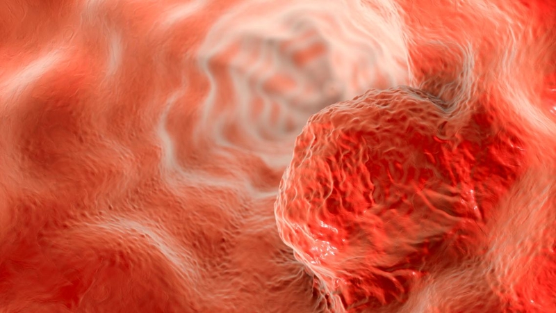 Nhiều bệnh nhân muốn biết ung thư vú giai đoạn 3 sống được bao lâu