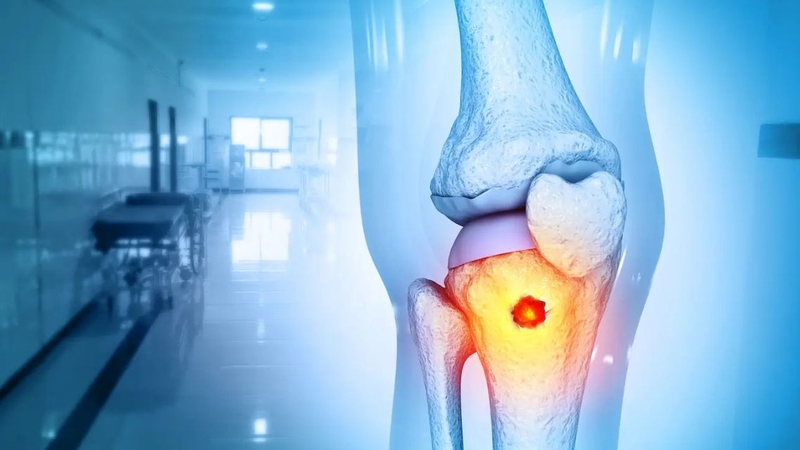Ung thư xương có thể gây đau và hạn chế vận động khi bệnh tiến triển