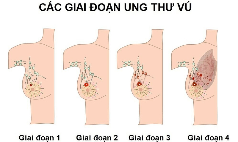 Nhận biết u vú lành tính và ung thư vú dựa vào tốc độ phát triển bệnh