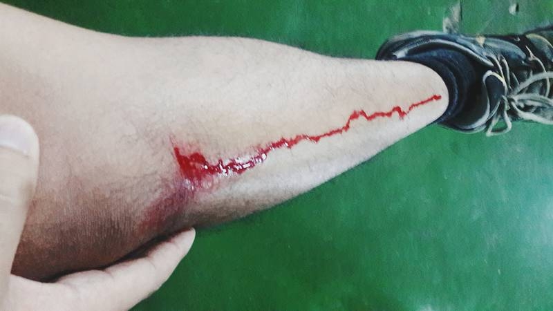 Uốn ván tác hại khôn lường - Cảnh giác từ những vết thương siêu nhỏ 2