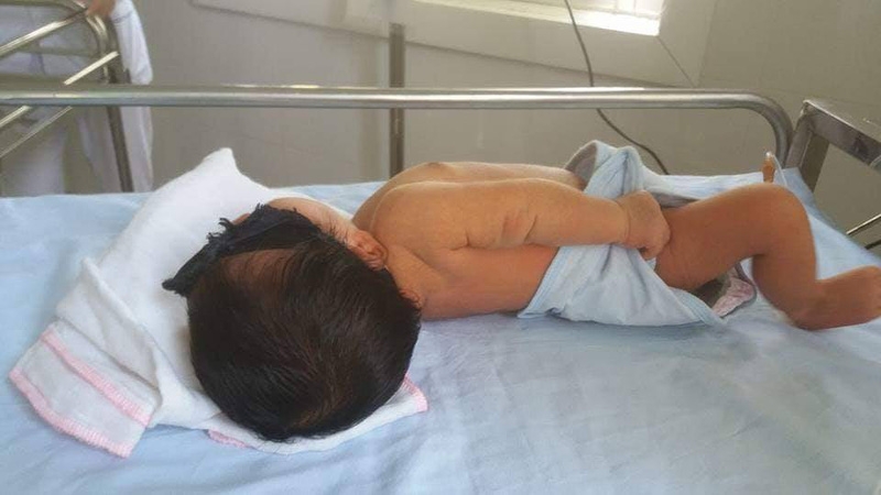 Uốn ván trẻ em - Những điều cha mẹ cần biết 2