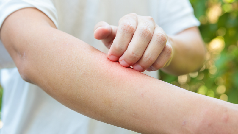 Dị ứng với rượu bia là một trong những nguyên nhân gây uống bia bị dị ứng ngứa